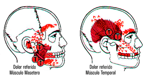 dolores referidos musculos masetero y temporal - Odontolog&iacute;a General y Est&eacute;tica
