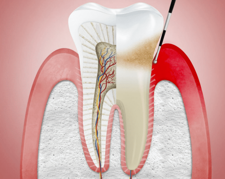 diente con enfermedad periodontal