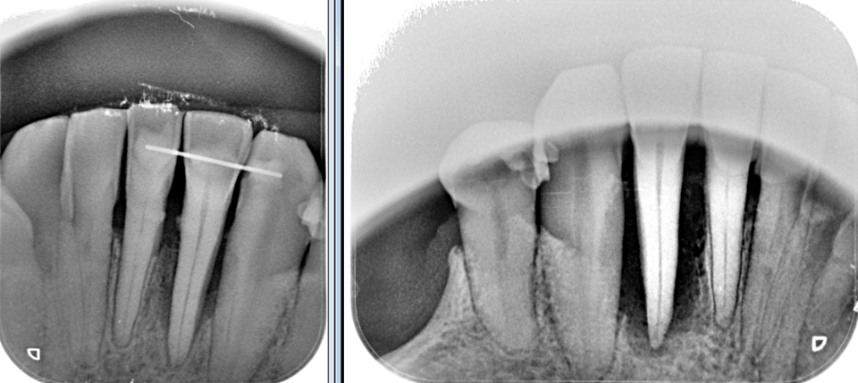 emdogain - Periodoncia