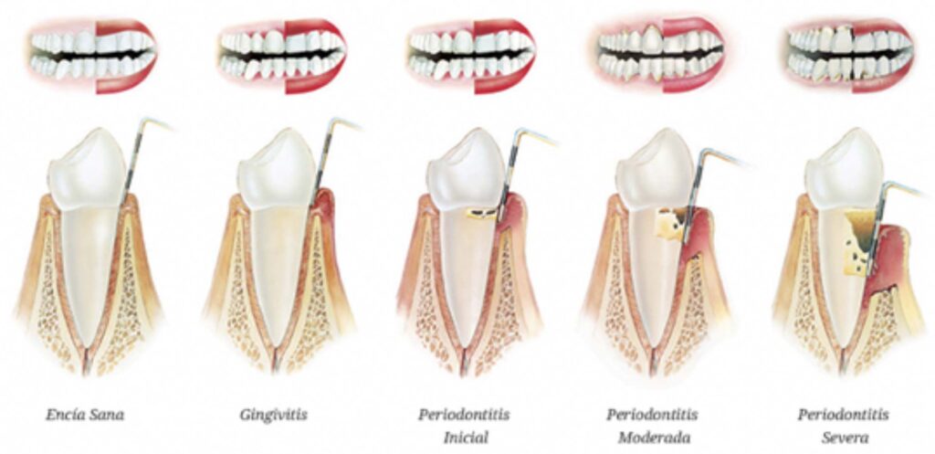 foto 21 e1784710525724 1024x497 - Periodoncia