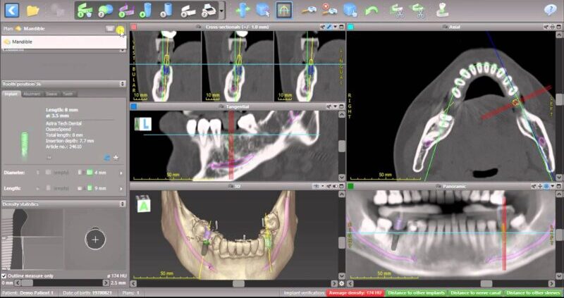 caso quirúrgico de planificación digital de colocación de implantes