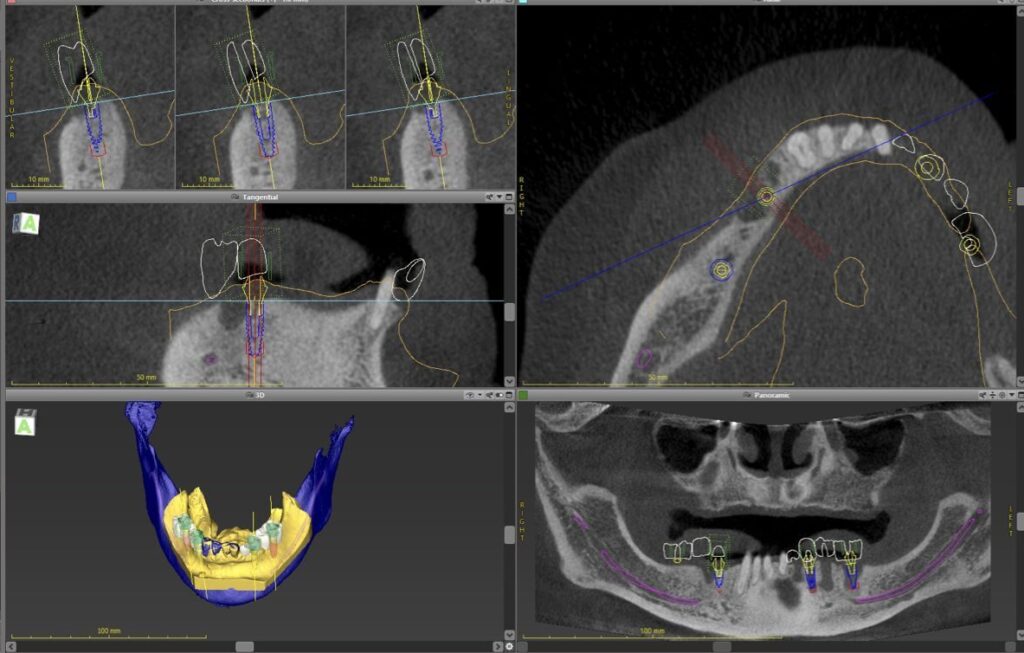 cirugia guiada e1784710115523 1024x653 - Implantes dentales