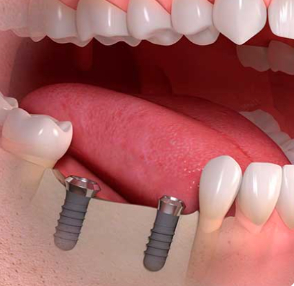 puente2 - Implantes dentales