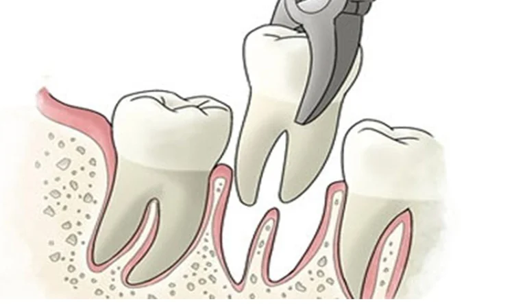 2029 clinica dental stoma alcorcon y mostoles extraccion de un diente 1.jpg - Odontolog&iacute;a General y Est&eacute;tica
