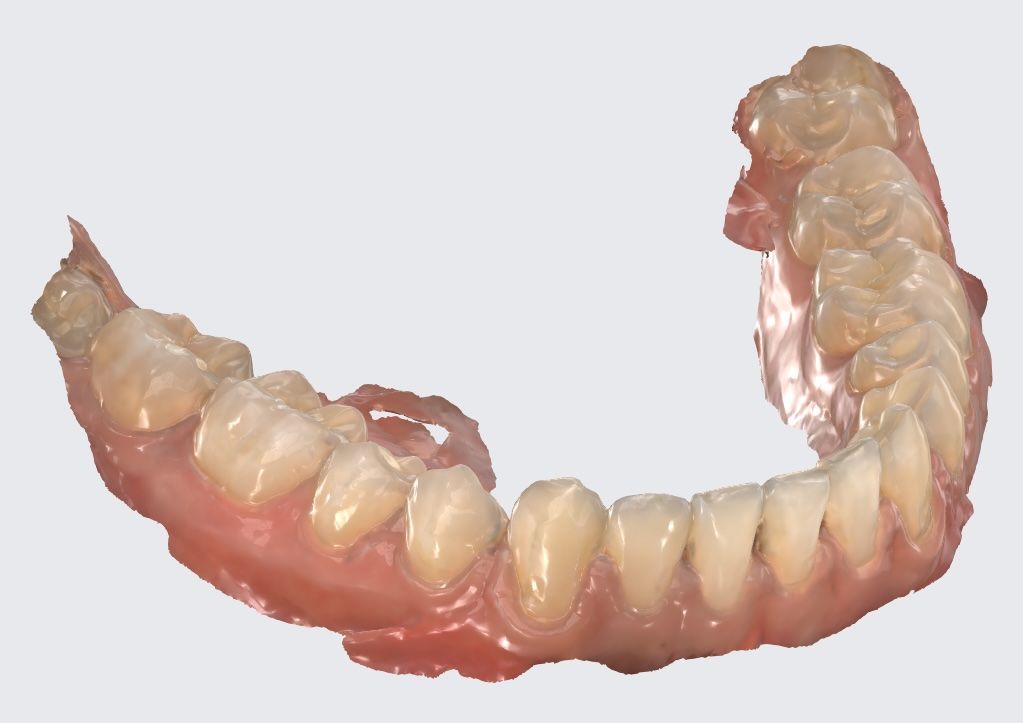 mandibula escaneada - Ortodoncia